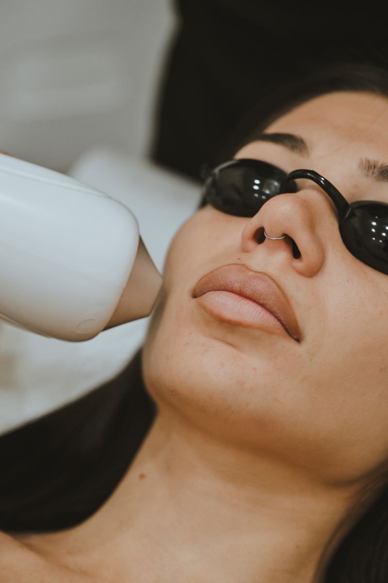 Laser hair removal